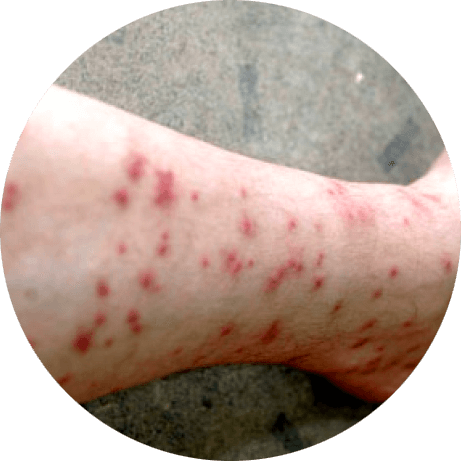 Bites from sand flies