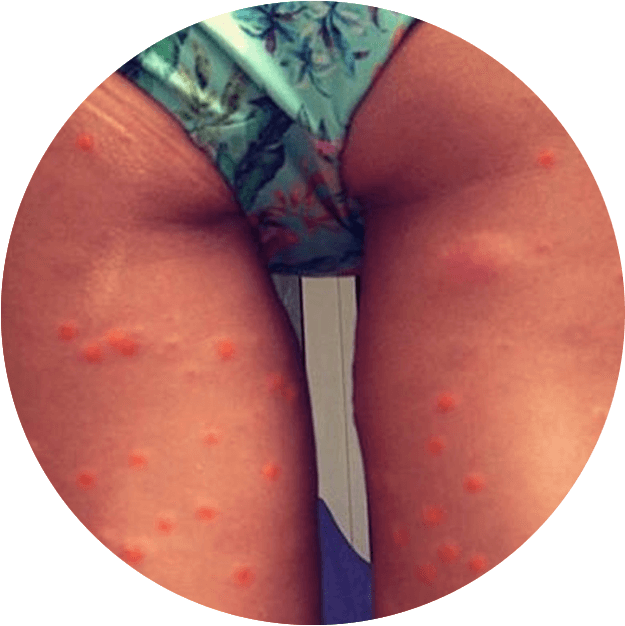 Circle Mosquito Bites Image